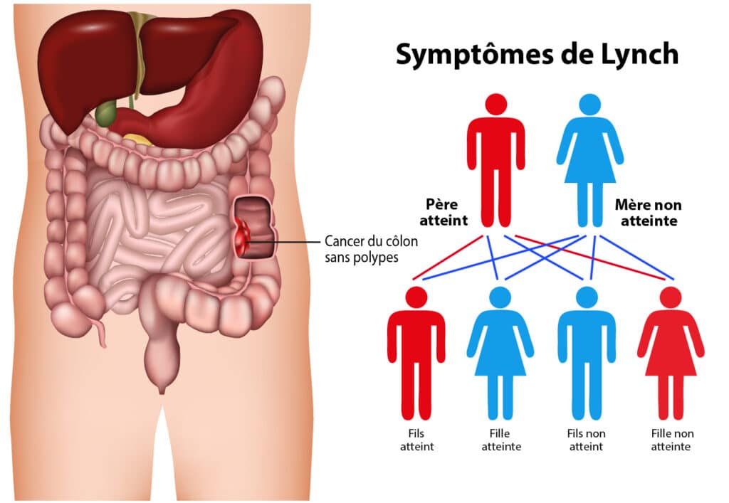 Syndrome de Lynch