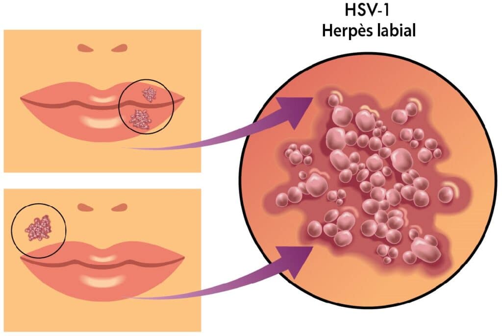 Herpès labial