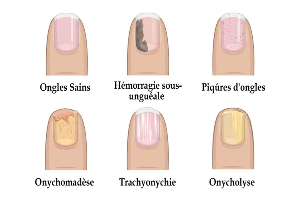 Les infections des ongles
