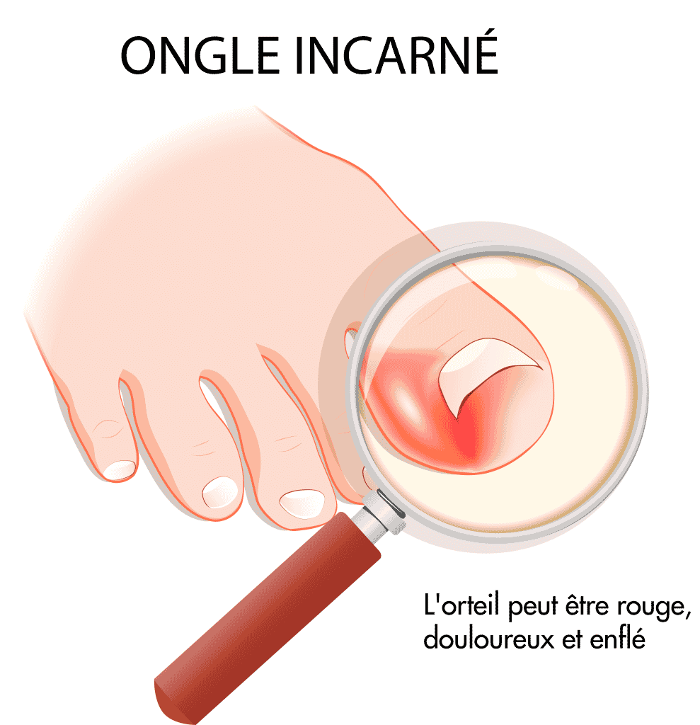 Ongle incarné – © Crédit : informationhospitaliere.com