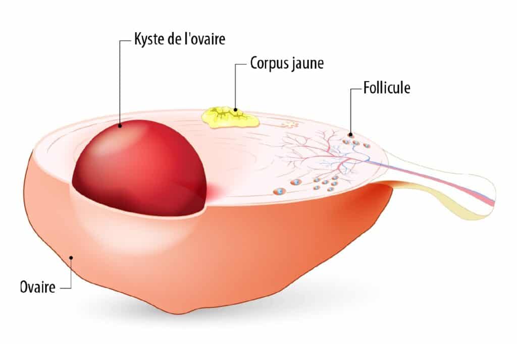 Kyste ovarien… quand faut-il s'inquiéter ? - Information ...