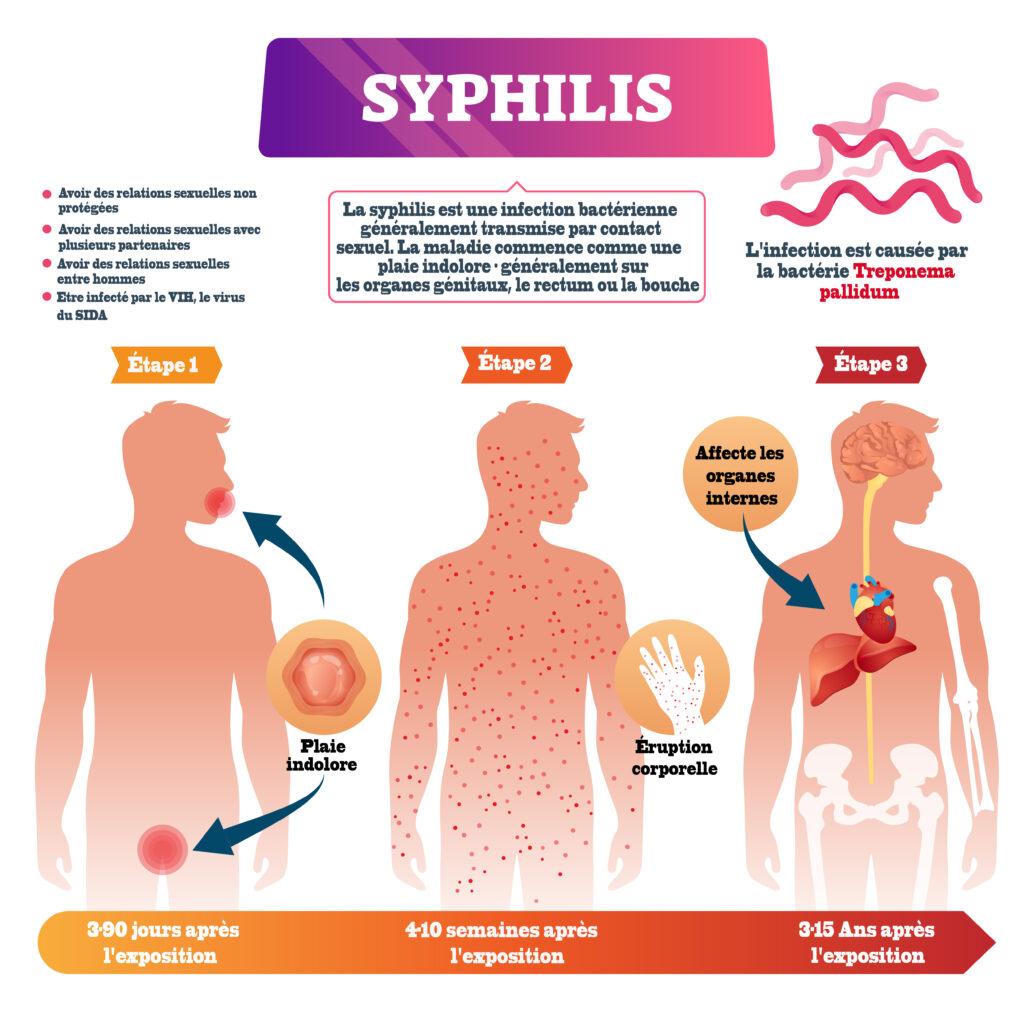 A propos de la syphilis