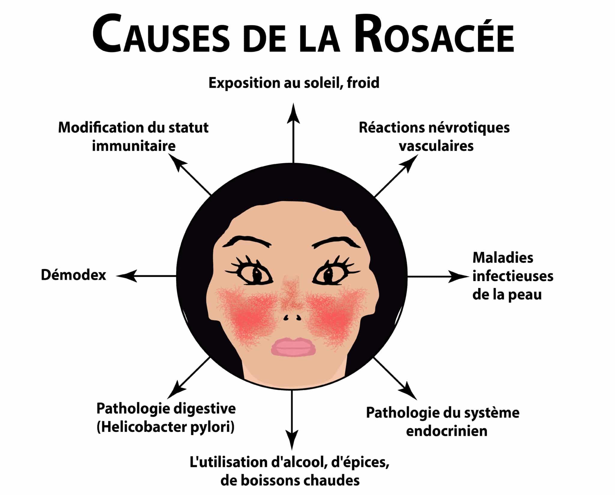 Acné Rosacée Causes, Symptômes et Traitements Information hospitalière Lexique et