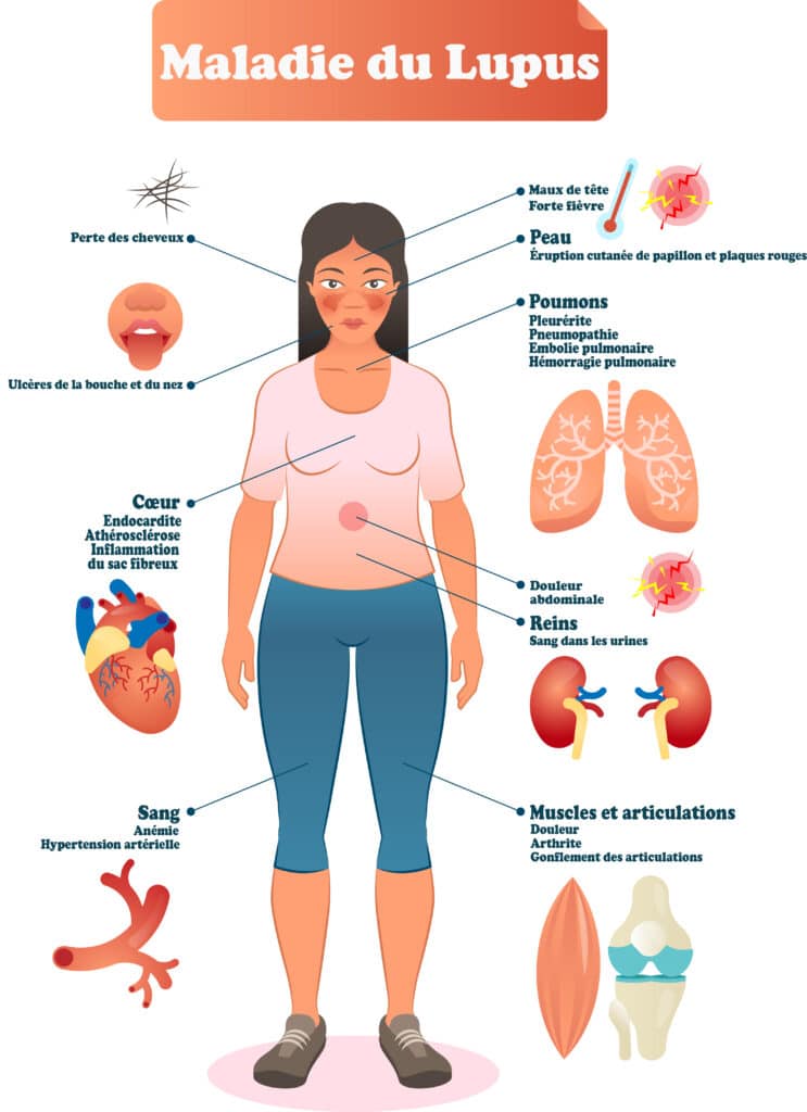 La maladie du Lupus – © Crédit : informationhospitaliere.com