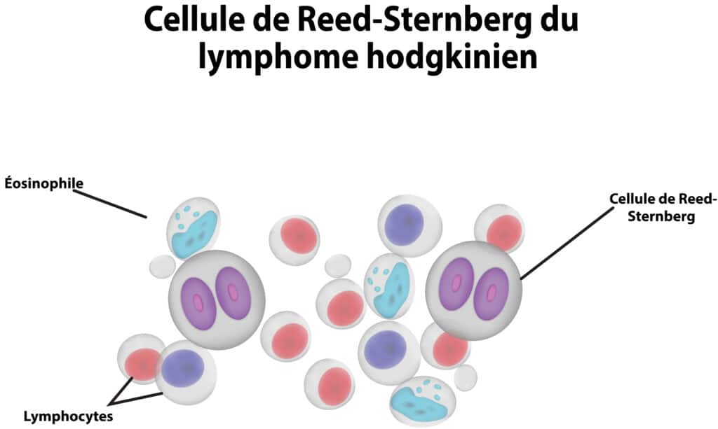 Les cellules de Reed-Sternberg – © Crédit : informationhospitaliere.com