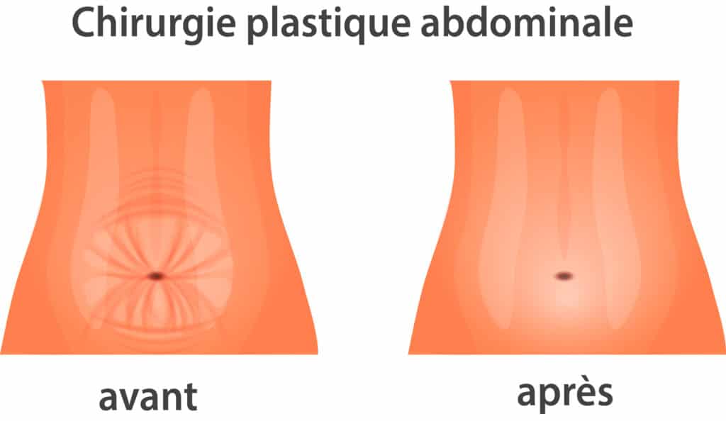 L'abdominosplatie – © Crédit : informationhospitaliere.com