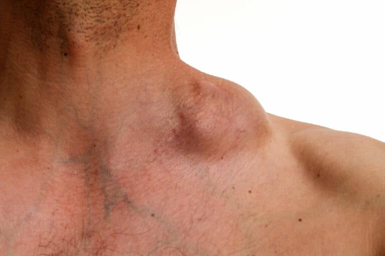 Les lymphomes : Causes, Symptômes et Traitements