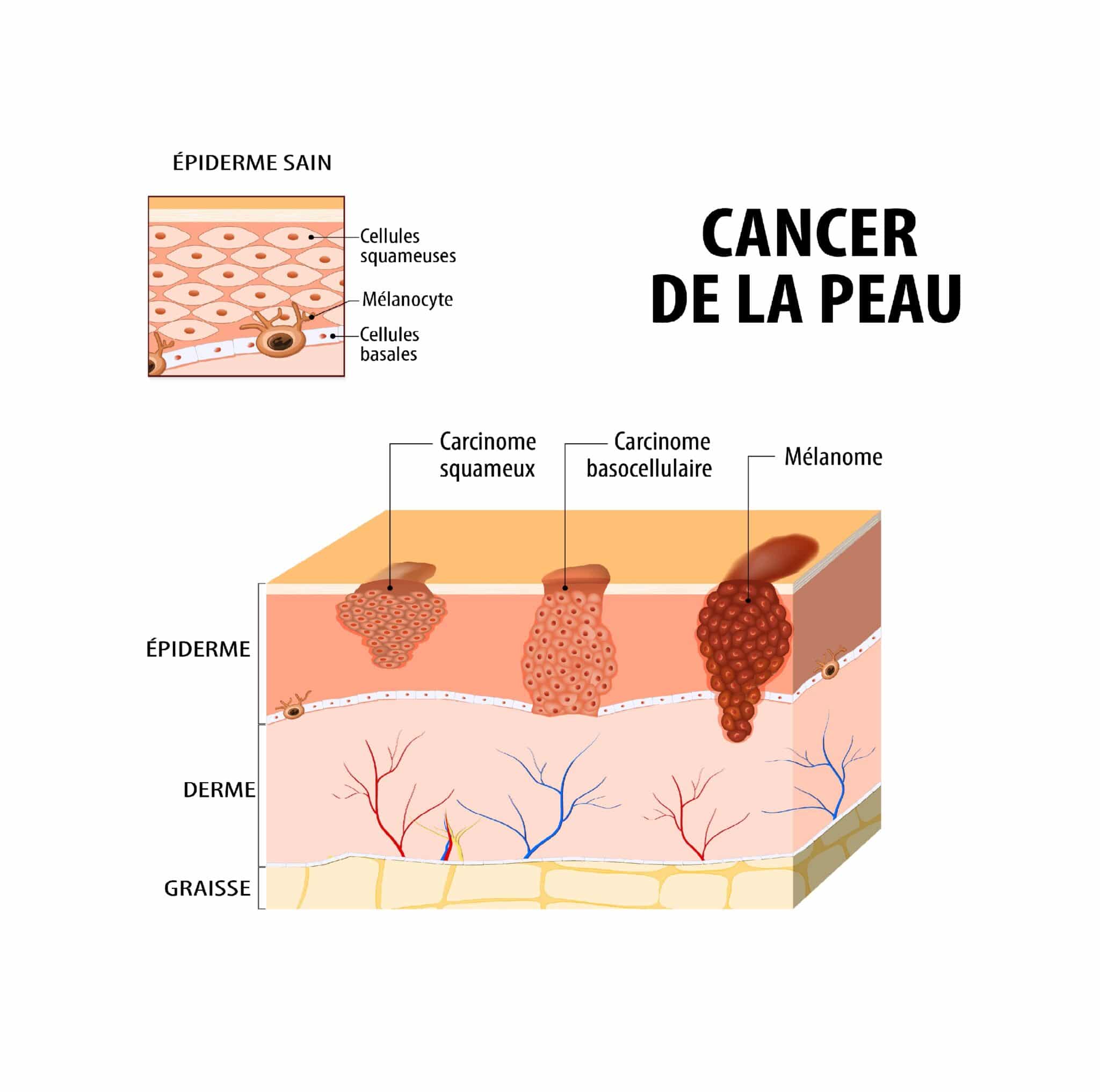 Cancer de la peau : Causes, Symptômes et Traitements - Information ...