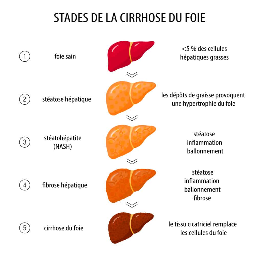 Stade de développement d'une fibrose  – © Crédit : informationhospitaliere.com