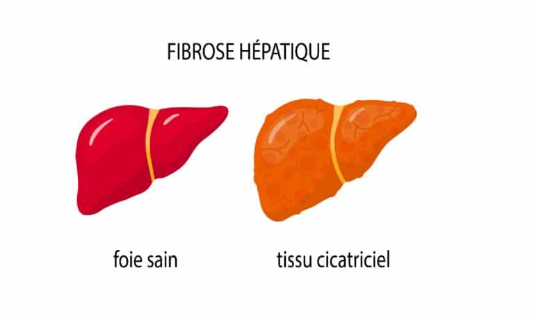 Fibrose hépatique : comment traiter la fibrose du foie?