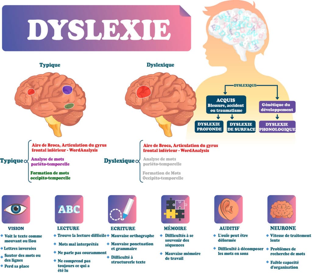 La dyslexie – © Crédit : informationhospitaliere.com