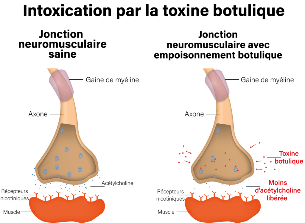 Intoxication par la toxine botulique – Crédit : informationhospitaliere.com