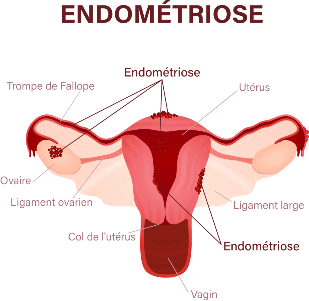 L'endométriose – © Crédit : informationhospitaliere.com
