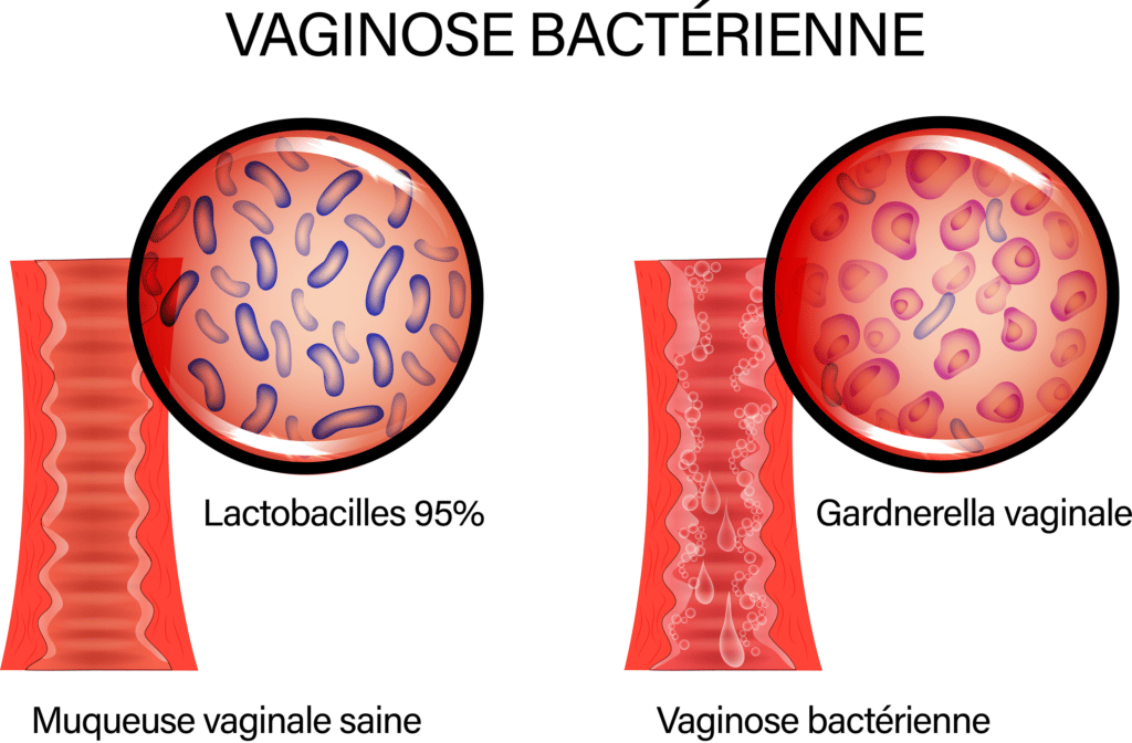 Vaginose bactérienne – © Crédit : informationhospitaliere.com