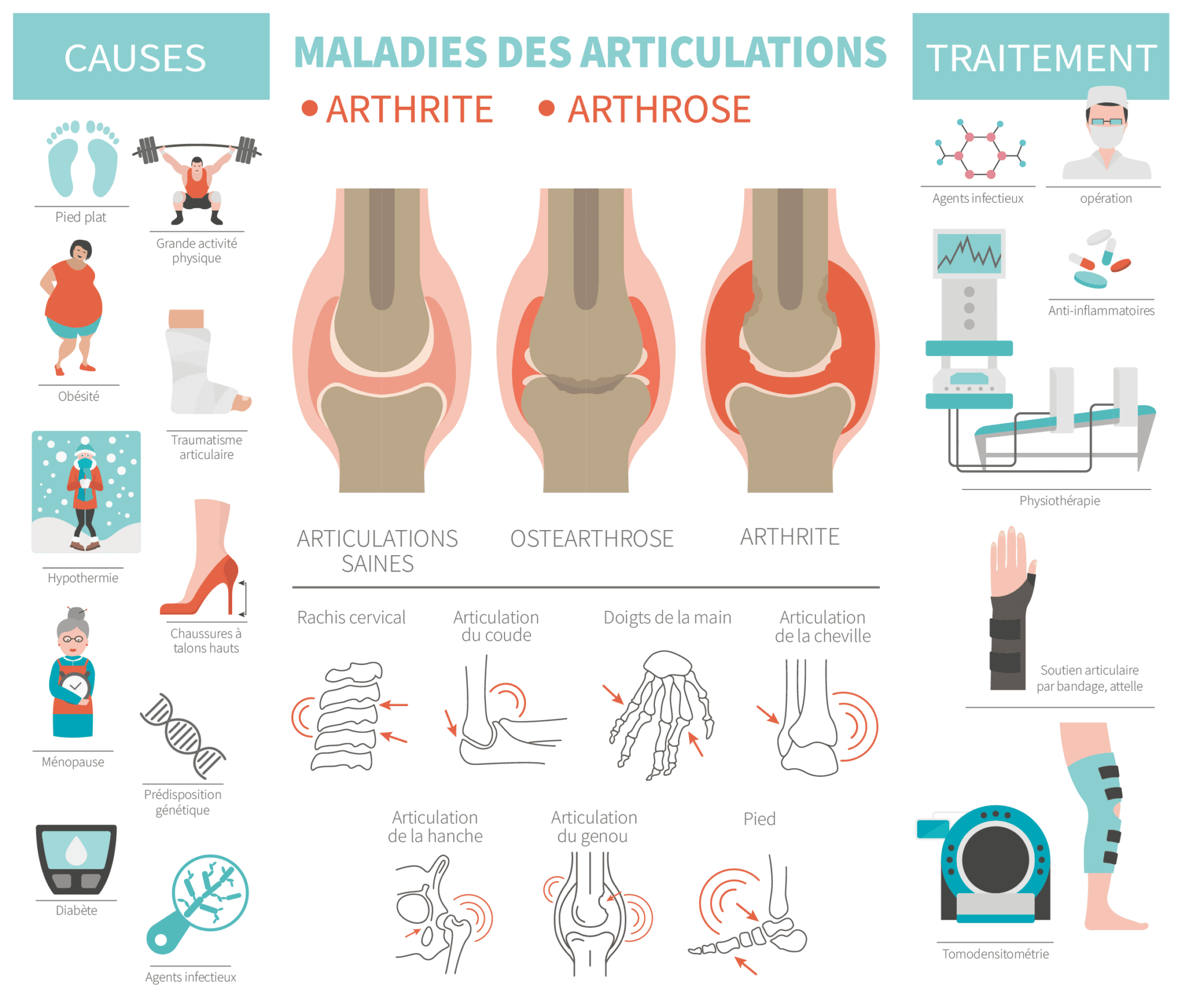Maladie des articulations – © Crédit : informationhospitaliere.com
