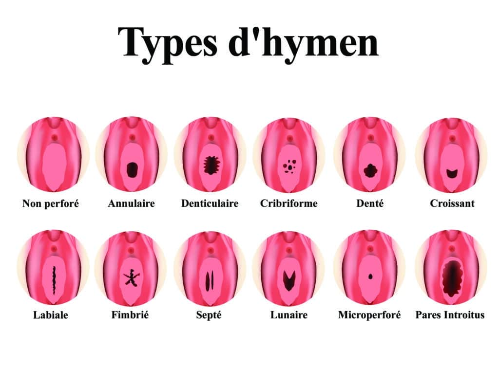 Différents types d'hymen – © Crédit : informationhospitaliere.com