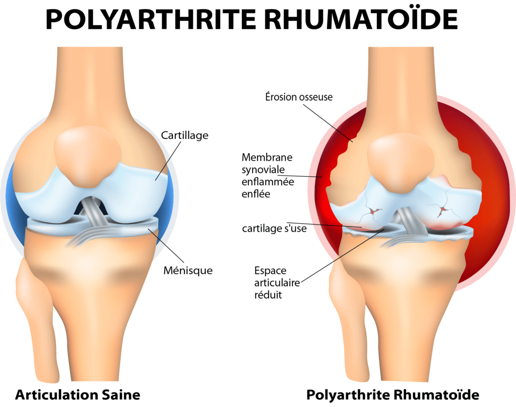 La polyarthrite rhumatoïde – © Crédit : informationhospitaliere.com