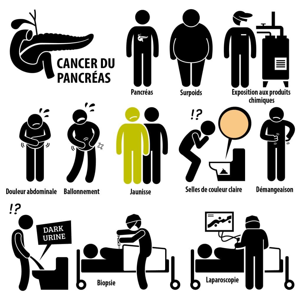 Symptômes du cancer du pancréas  – © Crédit : informationhospitaliere.com