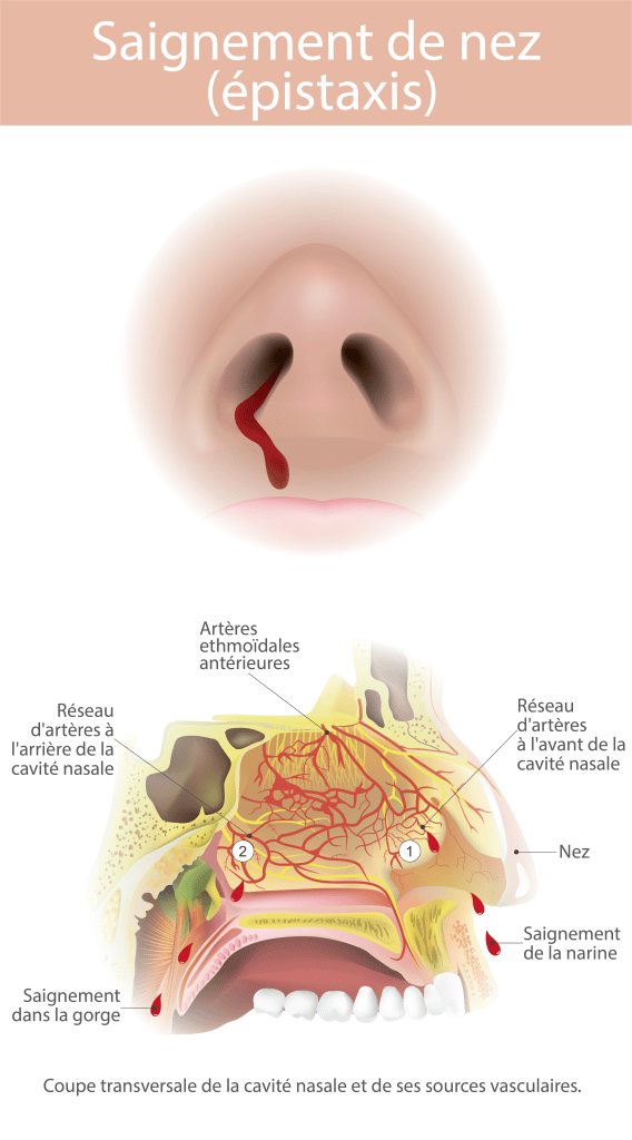 Cavités nasales et saignement du nez – Crédit : informationhospitaliere.com