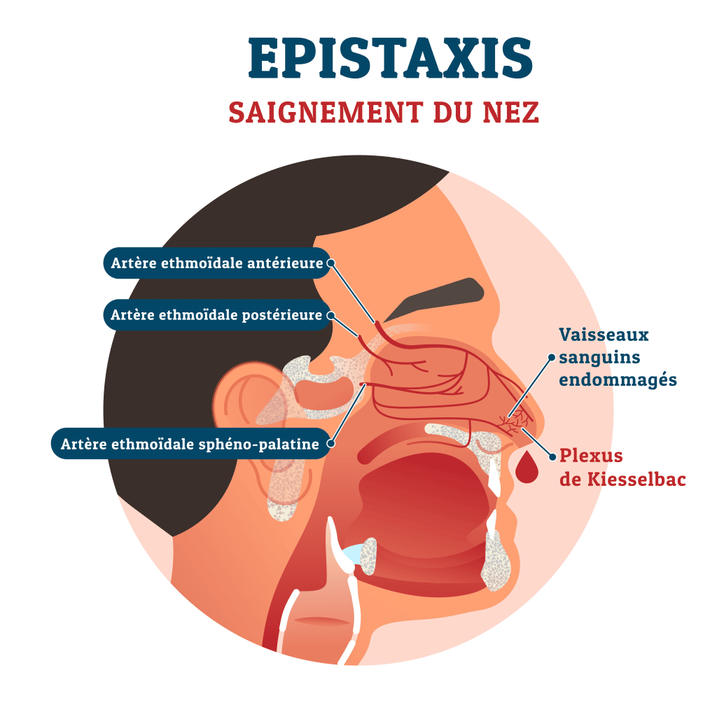 Saignement du nez – Crédit : informationhospitaliere.com
