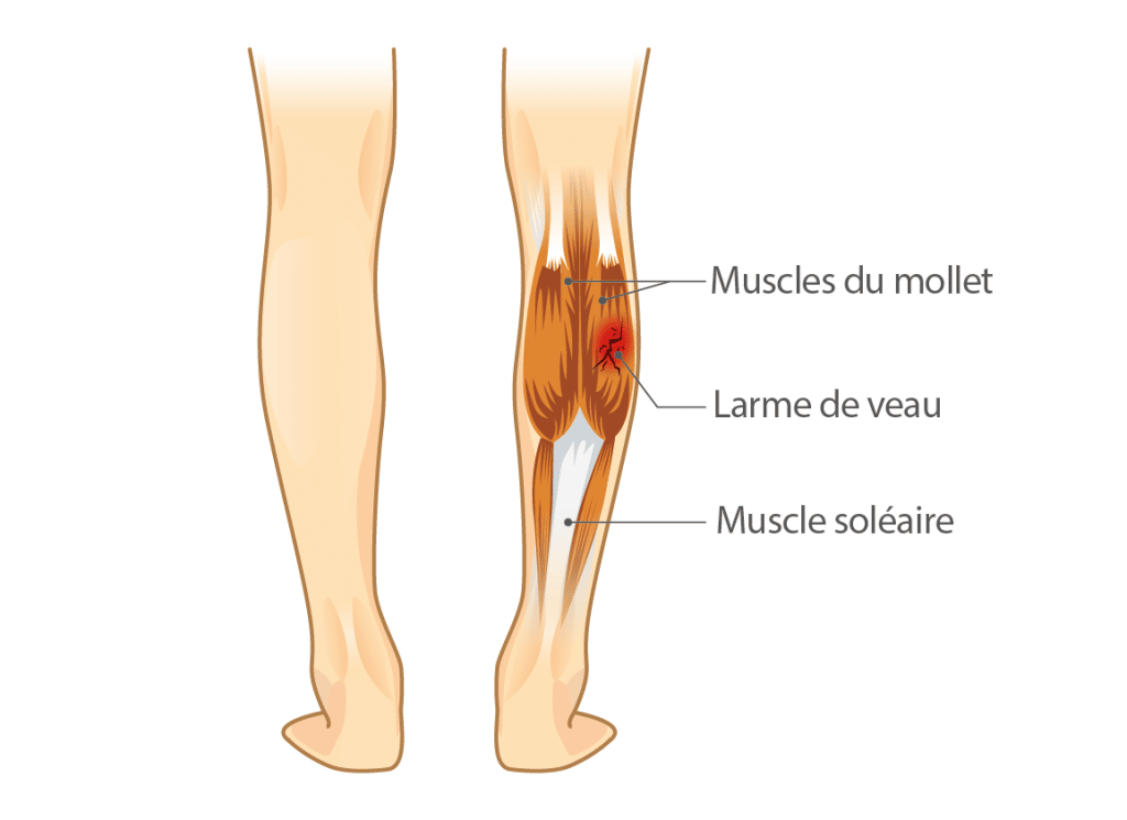Muscles du mollet – Crédit : informationhospitaliere.com