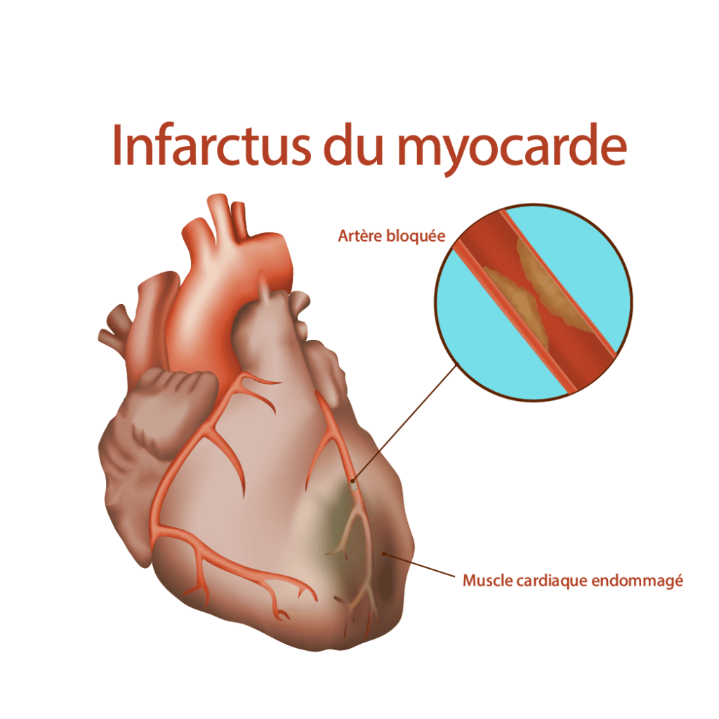 Infarctus du myocarde – Crédit : informationhospitaliere.com