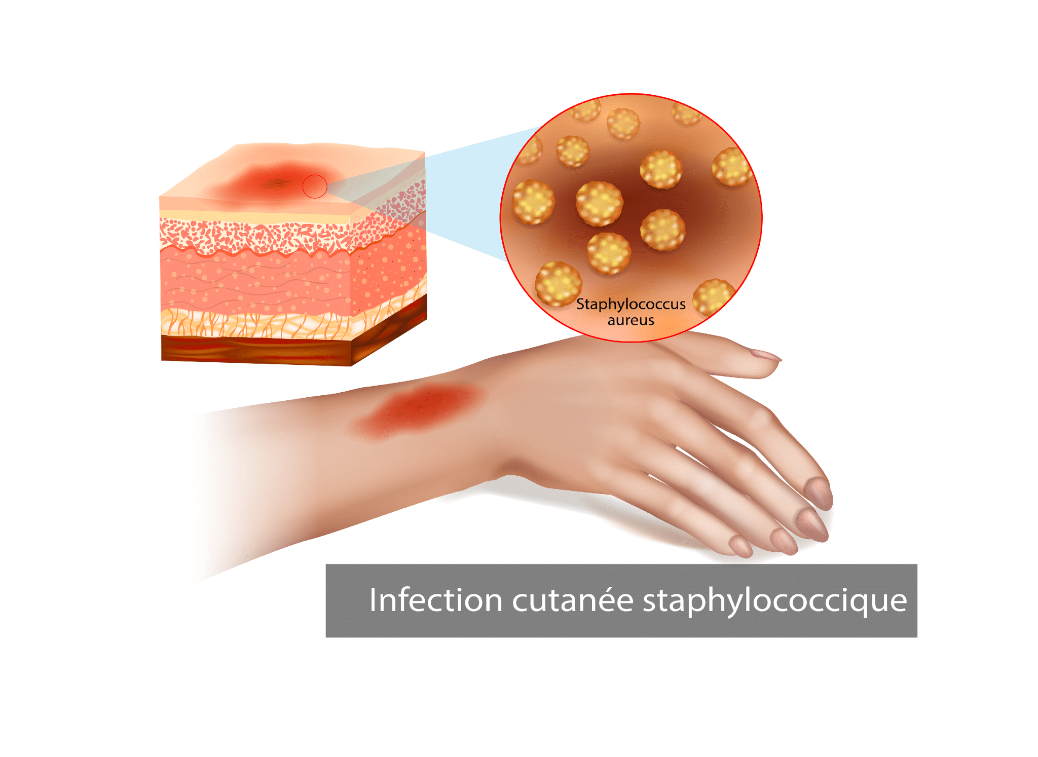 Staphylocoque doré : définition, symptômes et traitements -