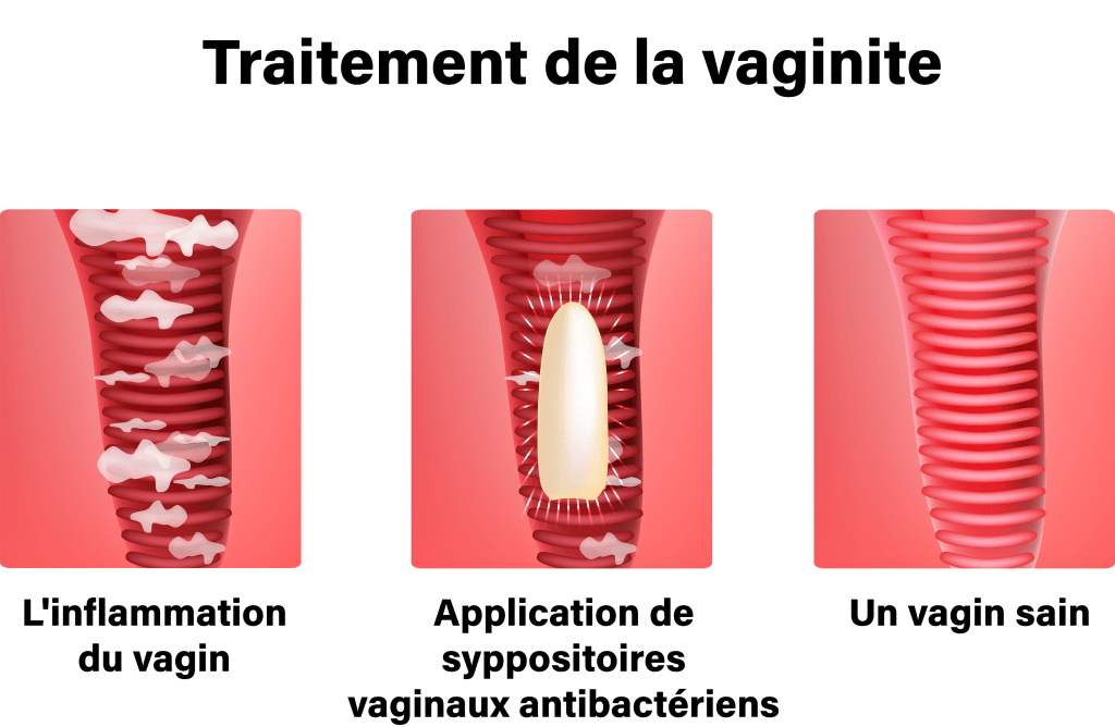 Traitement de la vaginite – Crédit : informationhospitaliere.com