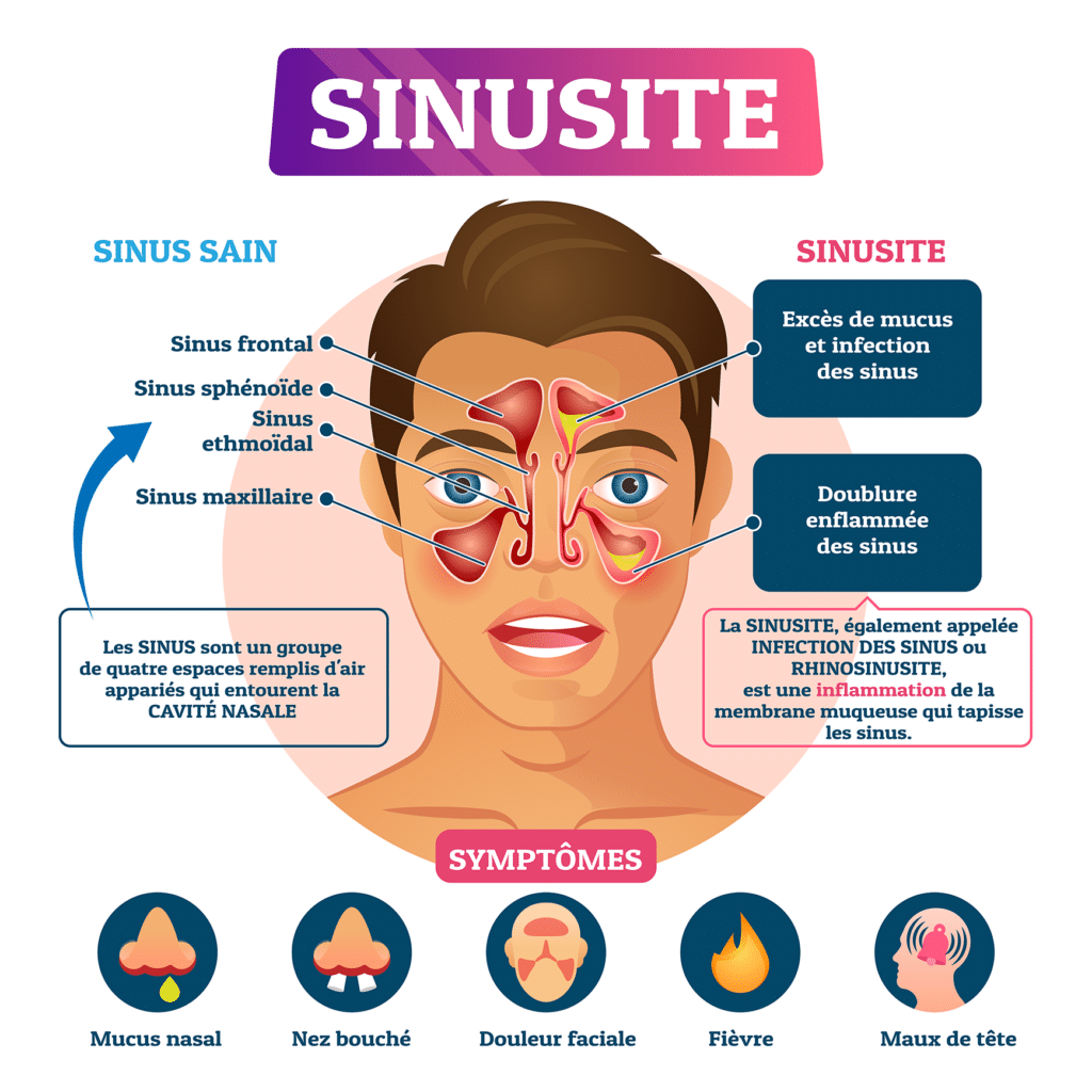 Sinusite chronique : causes, signes et traitements -