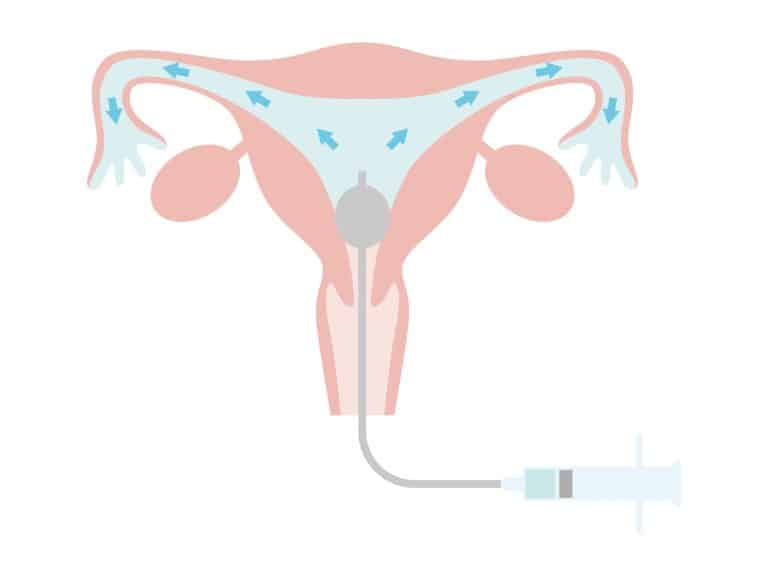 Hystérosalpingographie : comment se déroule cette radiographie ?