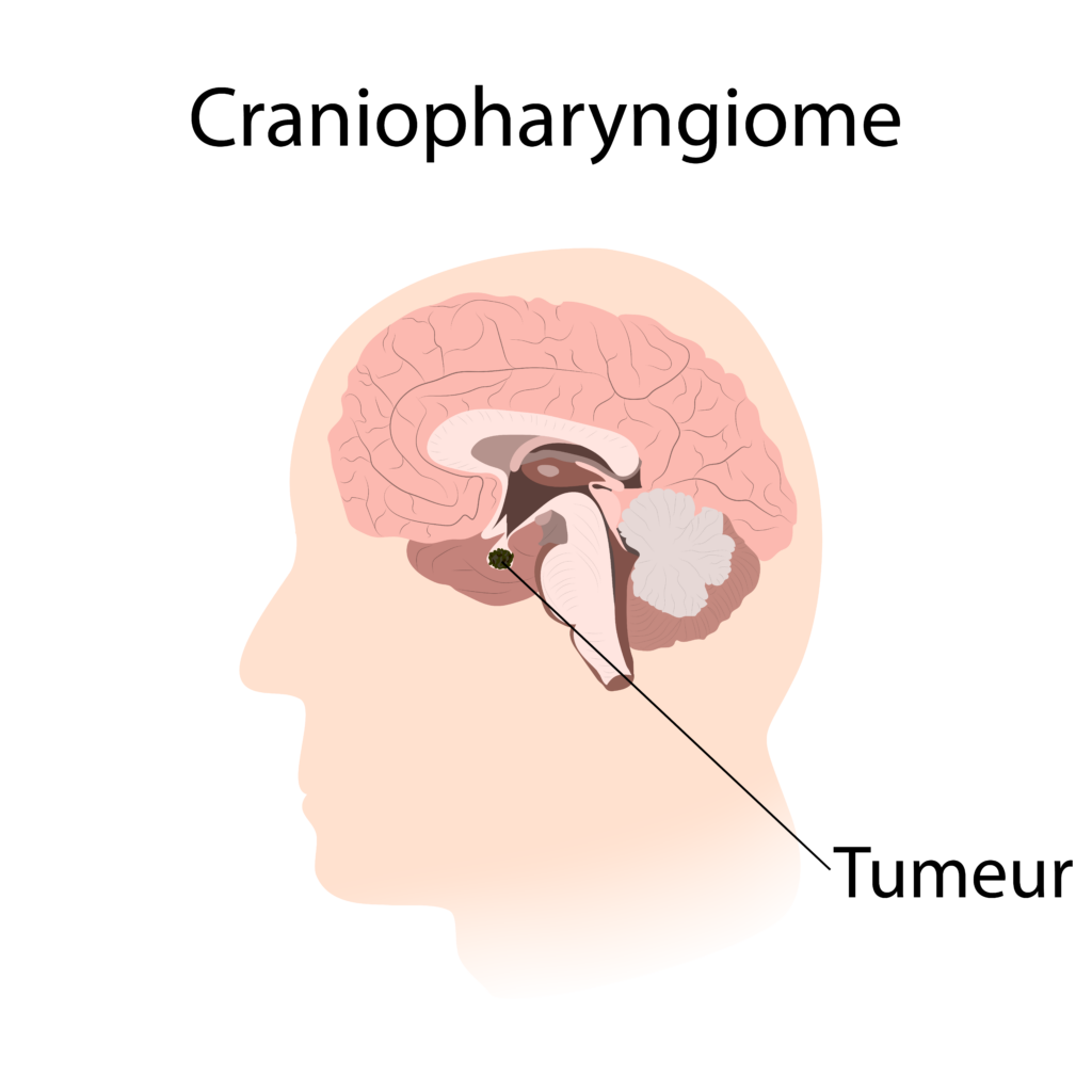 Craniopharyngiome – Crédit : informationhospitaliere.com