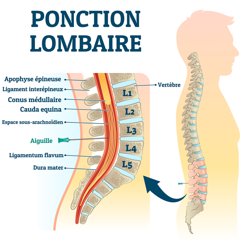 La ponction lombaire - Crédit : informationhospitaliere.com
