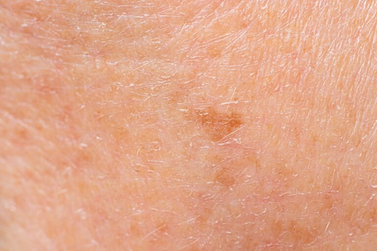 Comment prendre soin d’une peau sèche ?